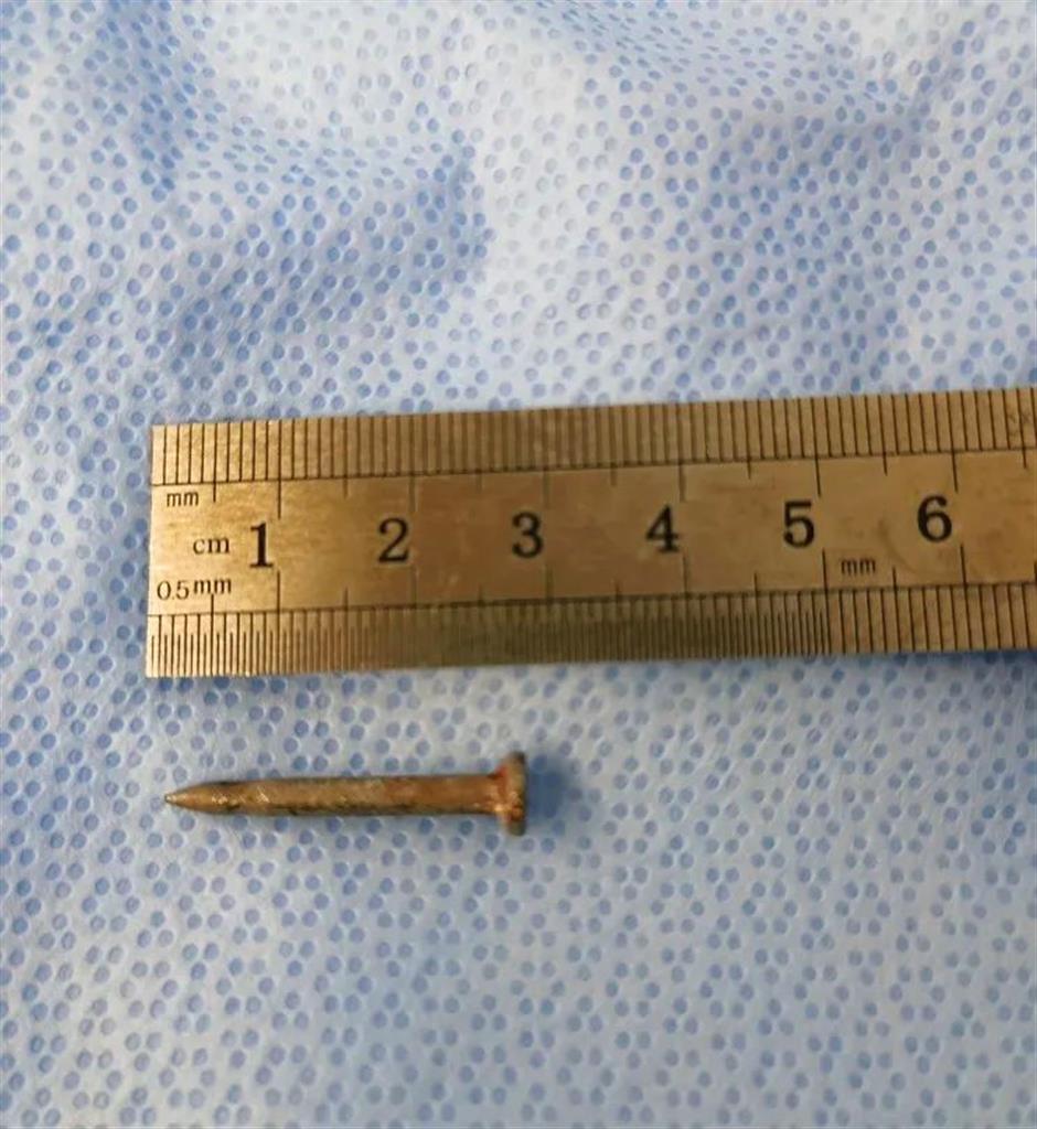 Doctors remove a 3-cm-long nail from a worker's body