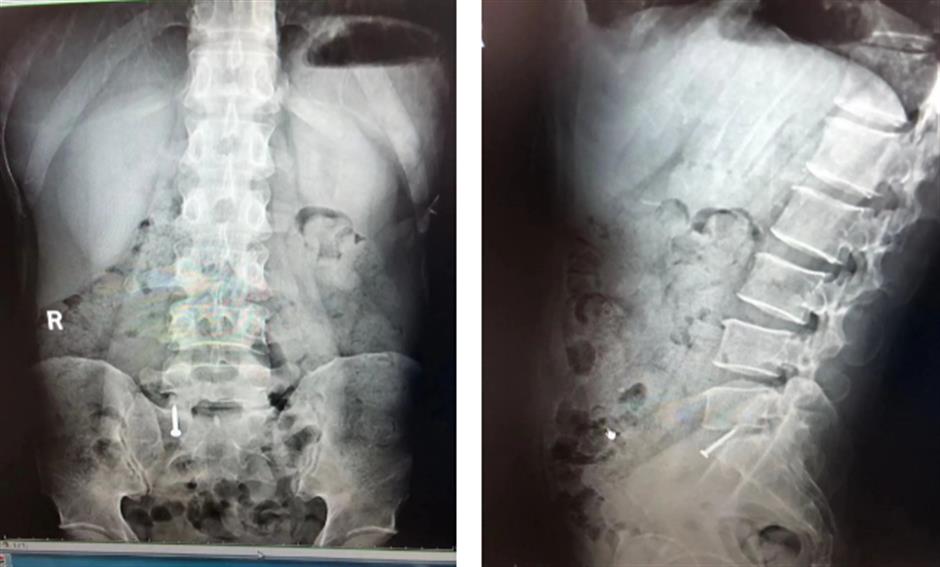 Doctors remove a 3-cm-long nail from a worker's body